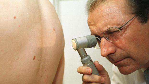 El melanoma es el cáncer de piel más peligroso